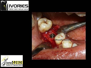 IMPLANT PLACEMENT BY PARTICIPANTS   